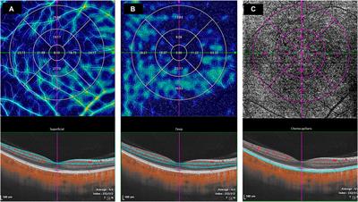 Assessment of macular structures and vascular characteristics in highly myopic anisometropia using swept-source optical coherence tomography angiography